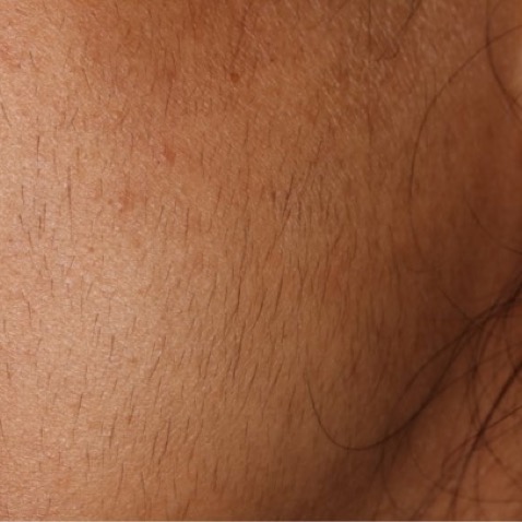 c2_ba_extra_fine_hair_removal_before