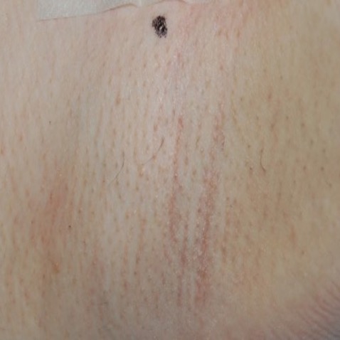 c2_ba_hair_removal_after