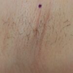 c2_ba_hair_removal_before