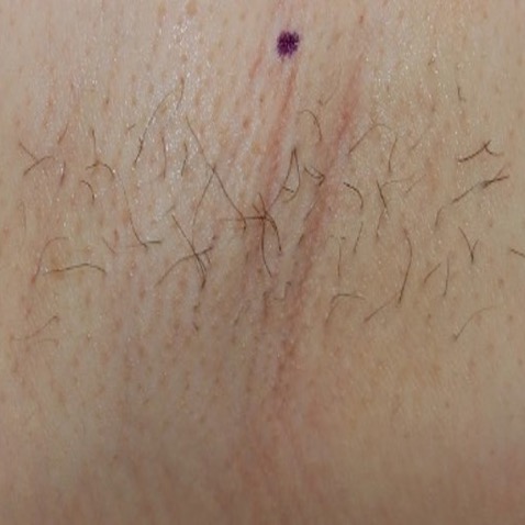 c2_ba_hair_removal_before