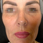 eco2-fine-fittings-med-spa-2-before-1_