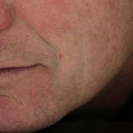 murgiamouthbeforetx2-1