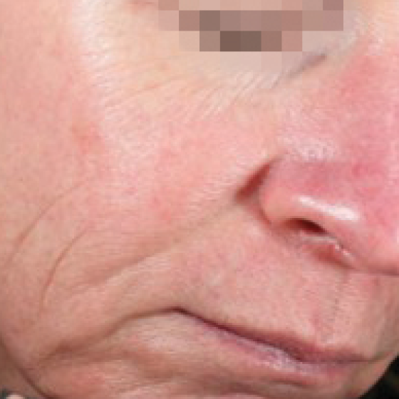 prd-1960-dermav-bnas-webformat-560x560-03