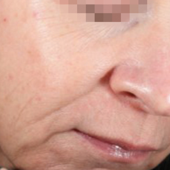 prd-1960-dermav-bnas-webformat-560x560-04