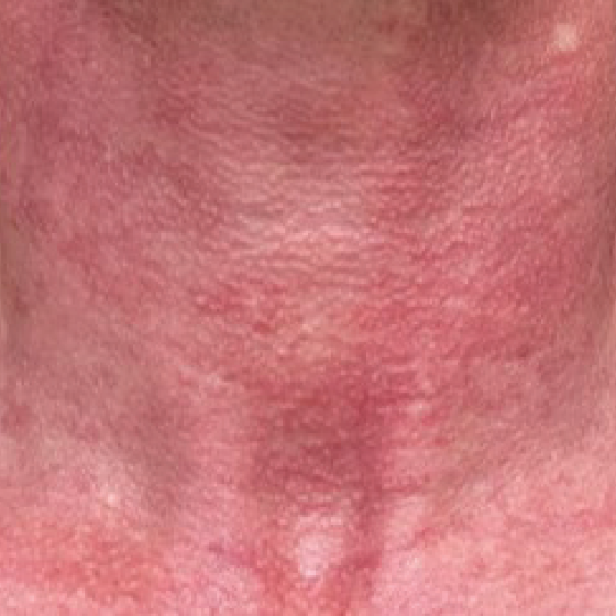 prd-1960-dermav-bnas-webformat-560x560-07