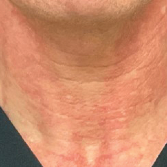 prd-1960-dermav-bnas-webformat-560x560-08