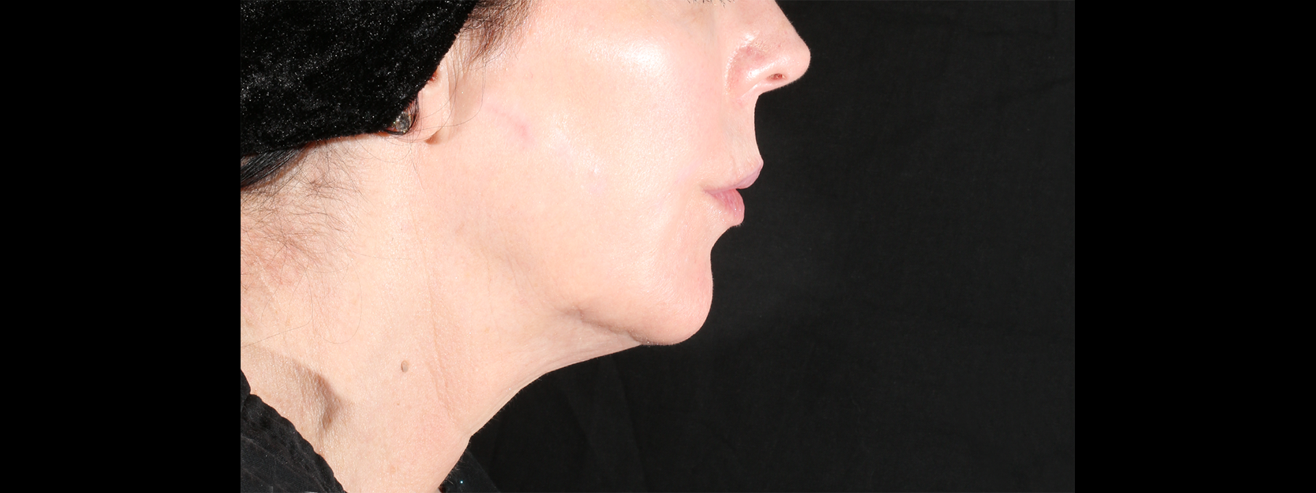 xerf-quibell-after-1