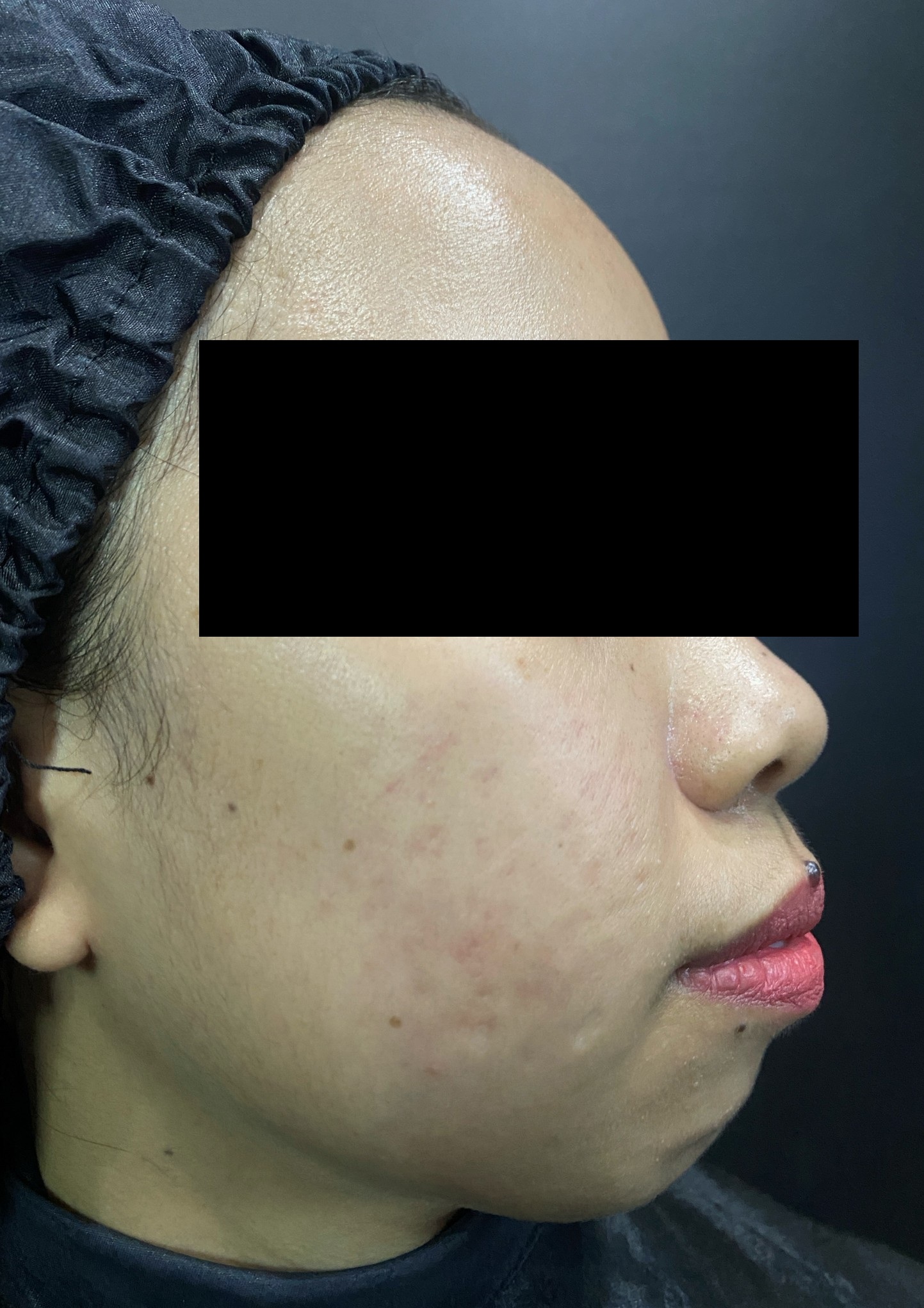 dr-ayu_erythema-post-acne-and-acne-scars_after