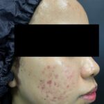 dr-ayu_erythema-post-acne-and-acne-scars_before