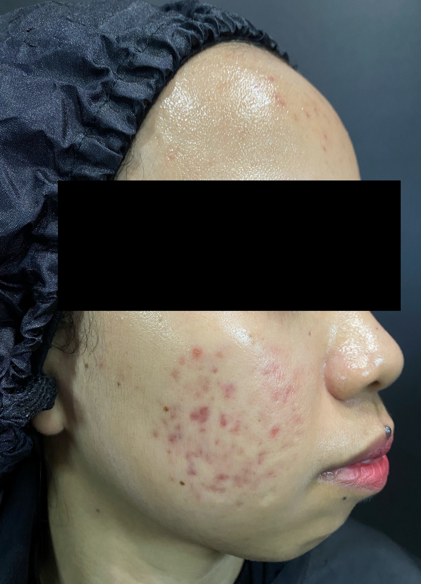 dr-ayu_erythema-post-acne-and-acne-scars_before