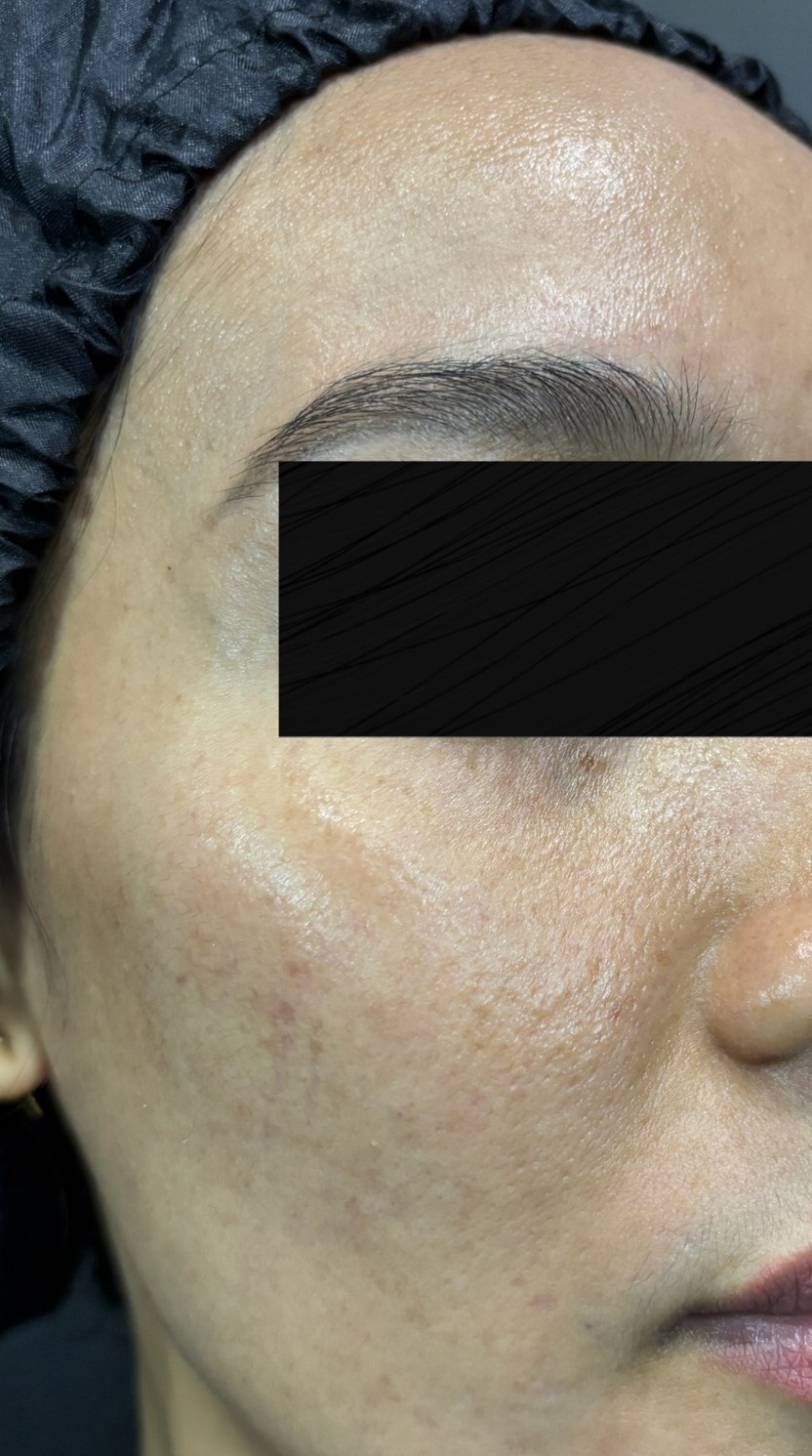 dr-ayu_hyperpigmentation-and-acne_left-side_after