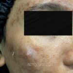 dr-ayu_hyperpigmentation-and-acne_left-side_before