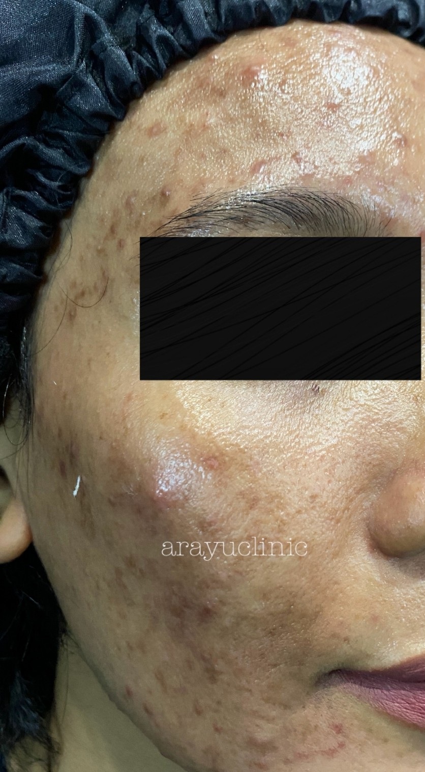 dr-ayu_hyperpigmentation-and-acne_left-side_before