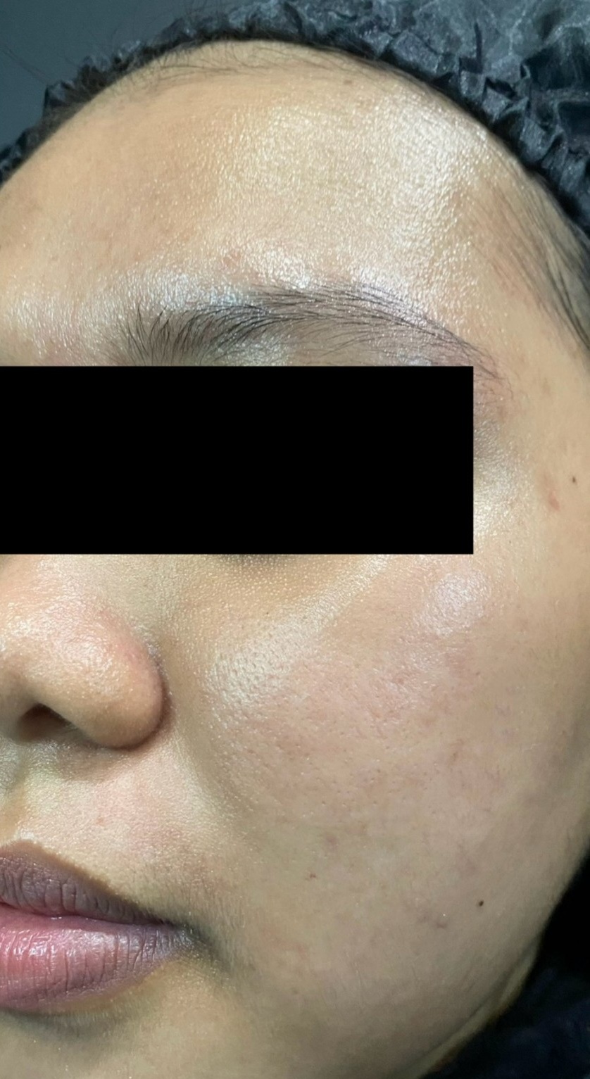 dr-ayu_hyperpigmentation-and-acne_right-side_after