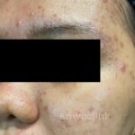 dr-ayu_hyperpigmentation-and-acne_right-side_before