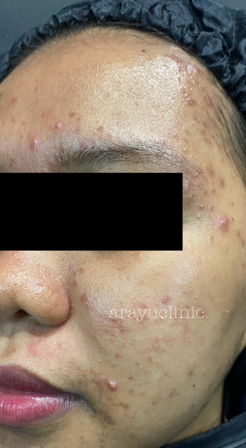 dr-ayu_hyperpigmentation-and-acne_right-side_before