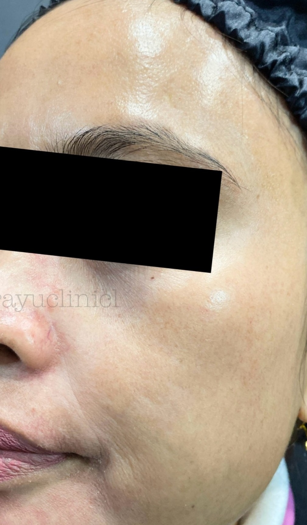 dr-ayu_melasma-and-rejuvenation_after