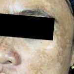 dr-ayu_melasma-and-rejuvenation_before