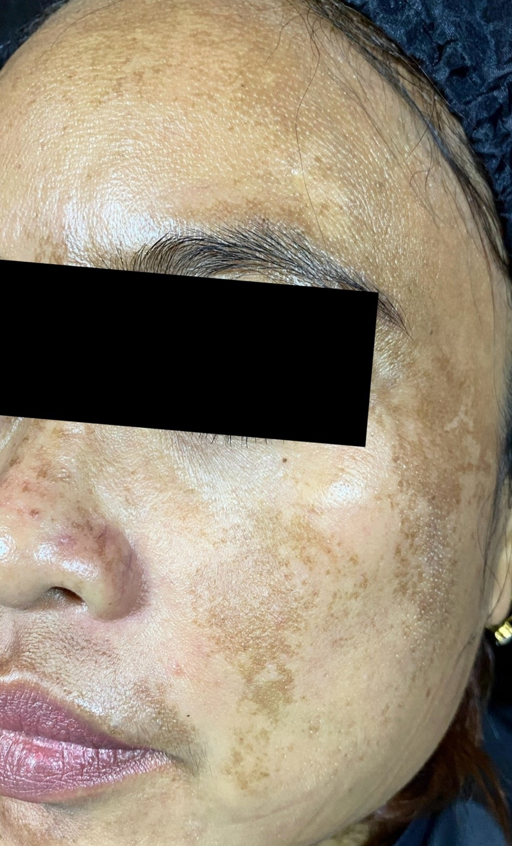 dr-ayu_melasma-and-rejuvenation_before