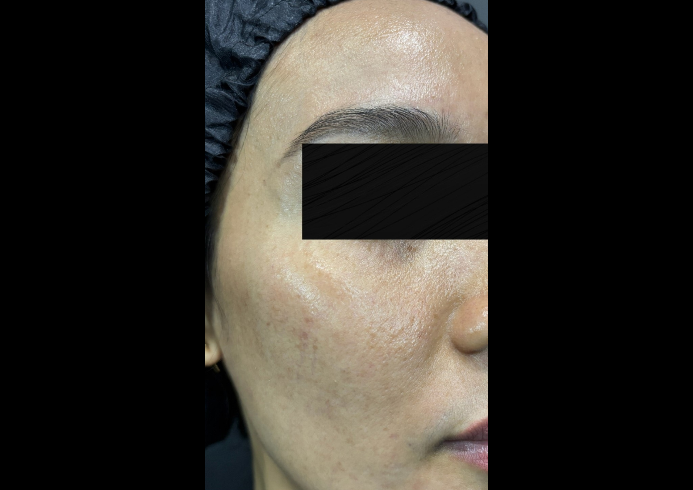 picov_dr-ayu_hyperpigmentation-and-acne_left-side_after