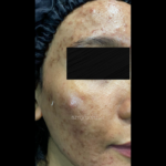 picov_dr-ayu_hyperpigmentation-and-acne_left-side_before