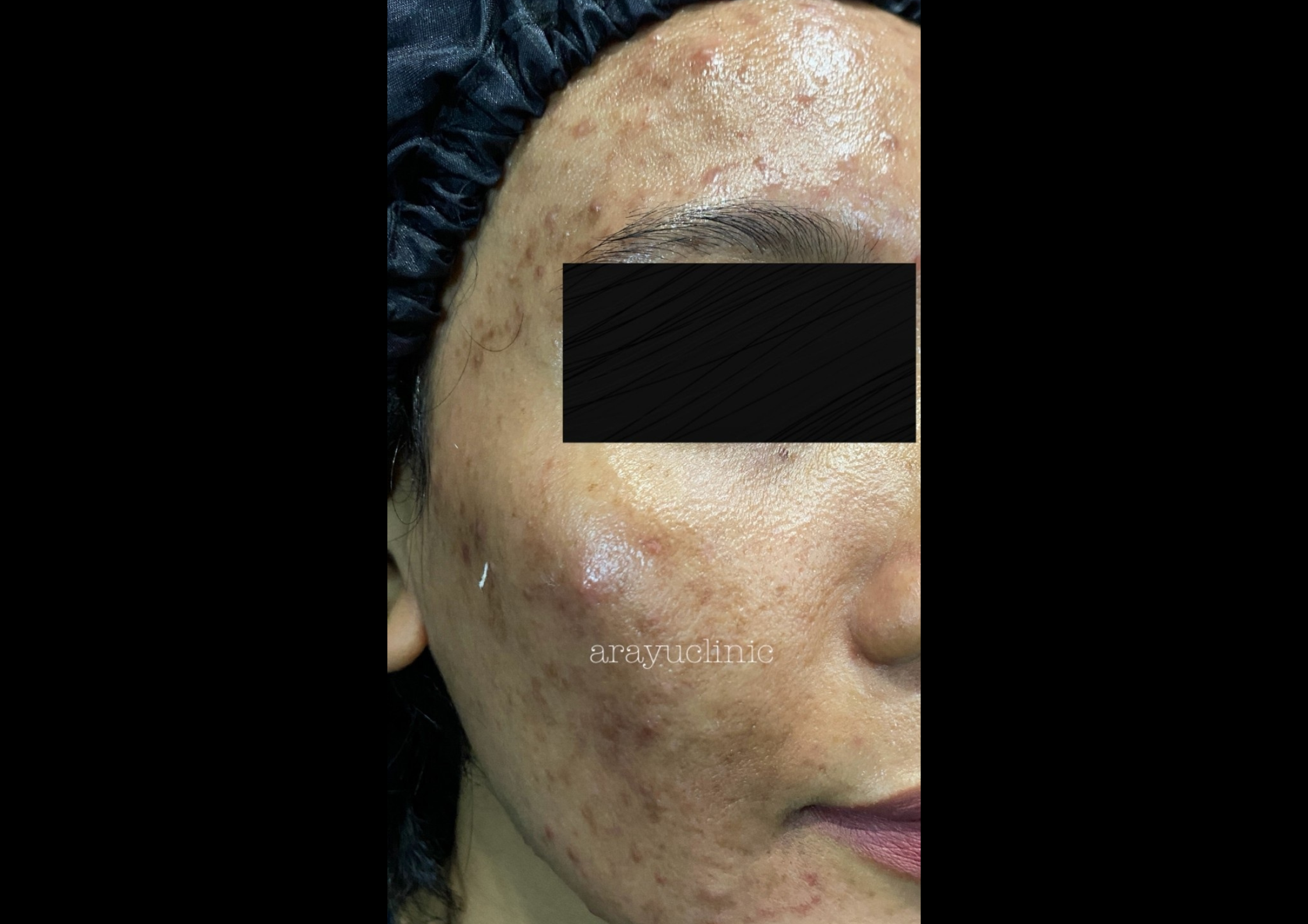 picov_dr-ayu_hyperpigmentation-and-acne_left-side_before