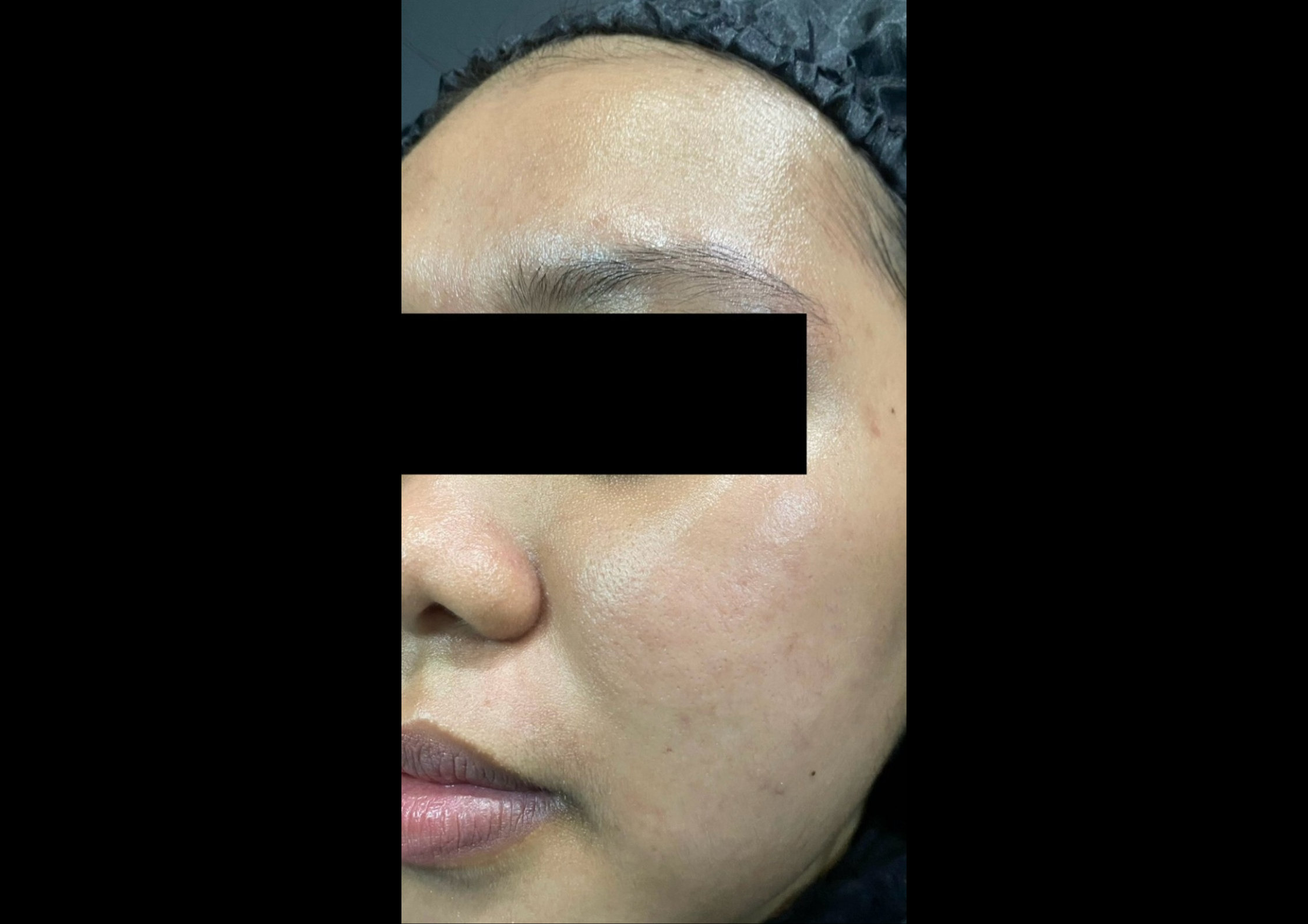picov_dr-ayu_hyperpigmentation-and-acne_right-side_after