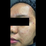 picov_dr-ayu_hyperpigmentation-and-acne_right-side_before