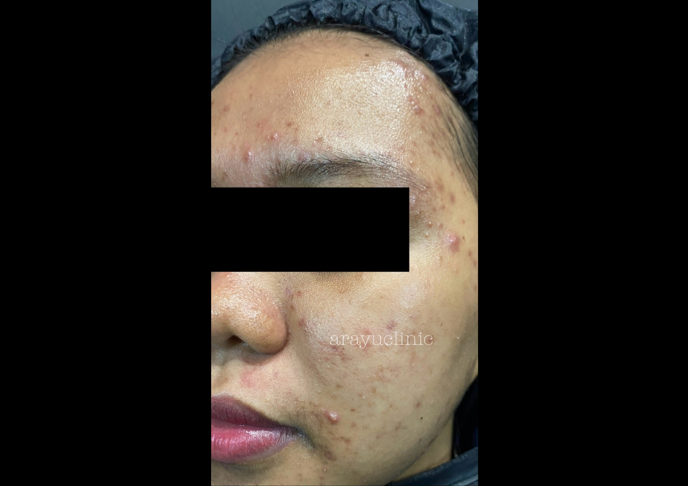 picov_dr-ayu_hyperpigmentation-and-acne_right-side_before