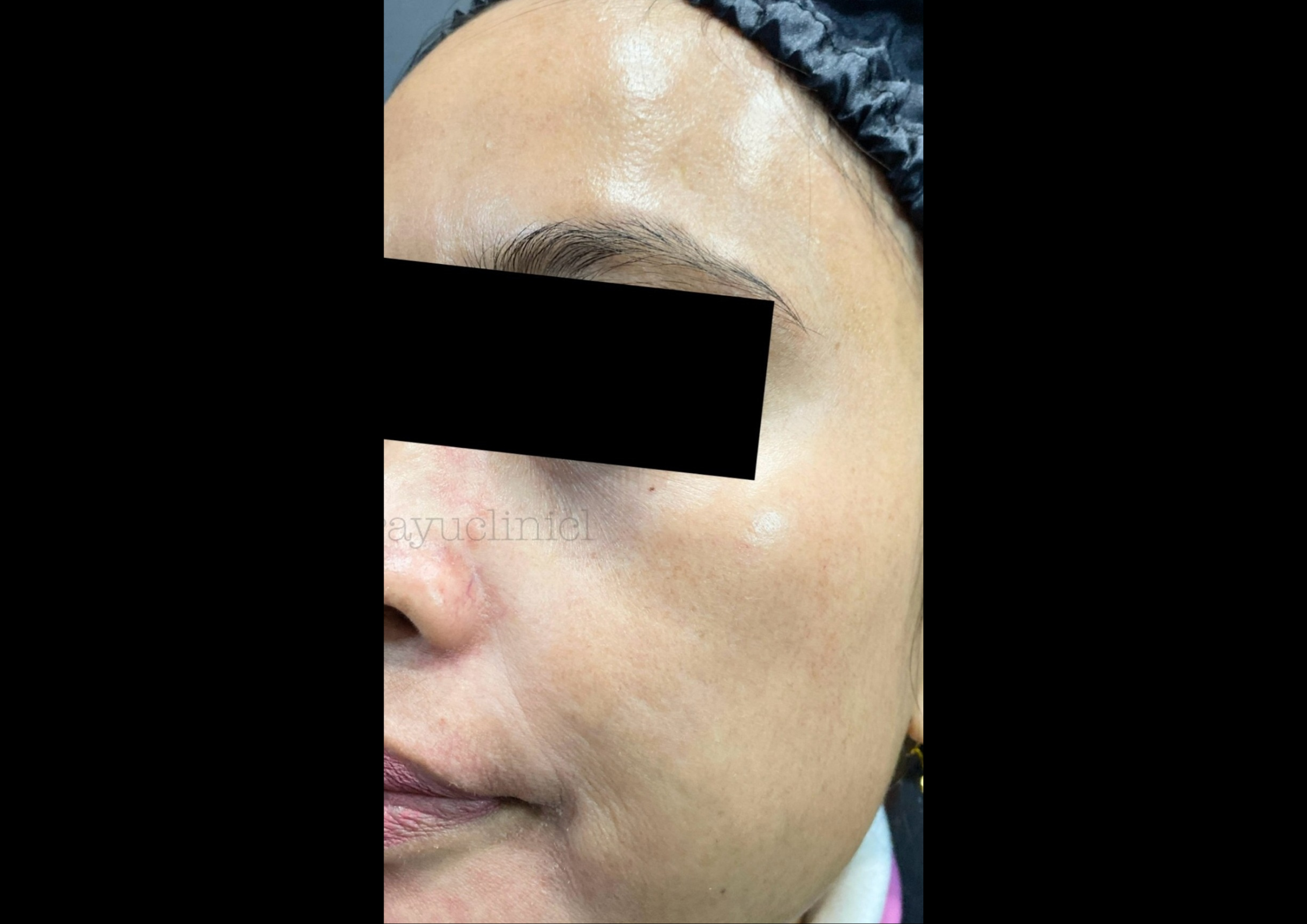 picov_dr-ayu_melasma-and-rejuvenation_after