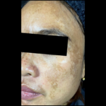 picov_dr-ayu_melasma-and-rejuvenation_before