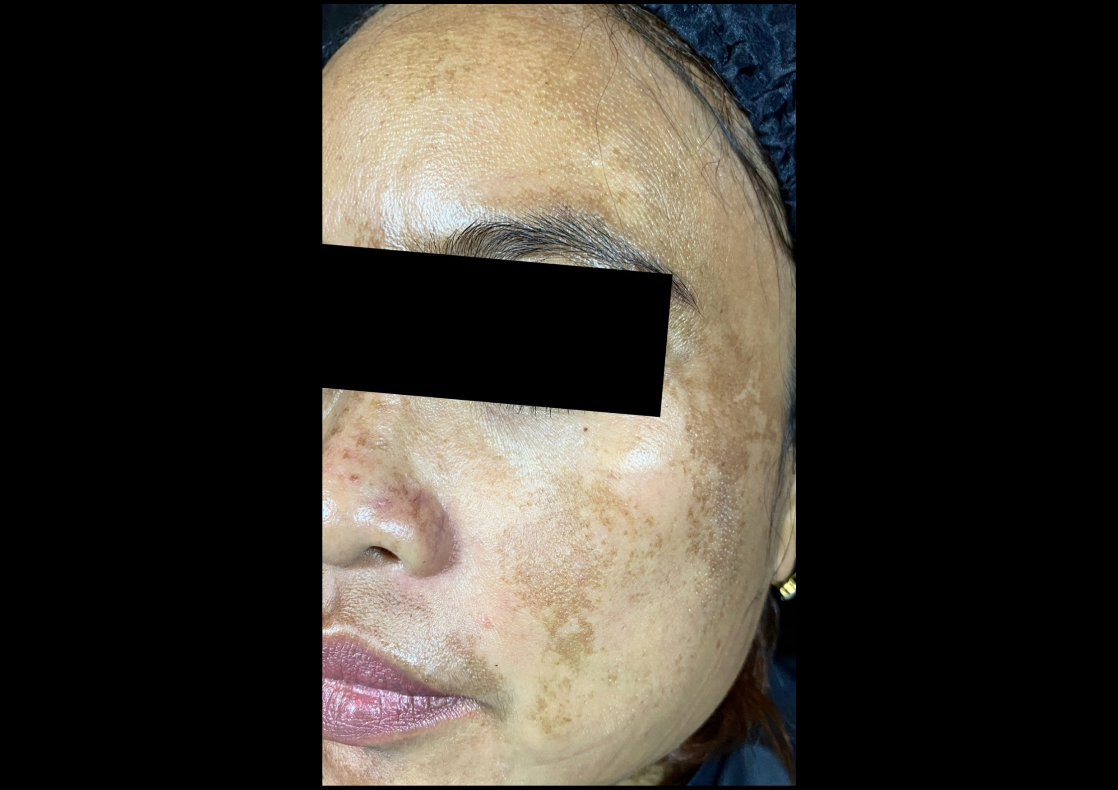 picov_dr-ayu_melasma-and-rejuvenation_before