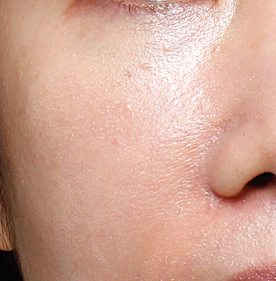 ultra_dr-may-lee_pore-size-and-dystonia_ba_after-3-sessions