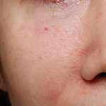 ultra_dr-may-lee_pore-size-and-dystonia_ba_before