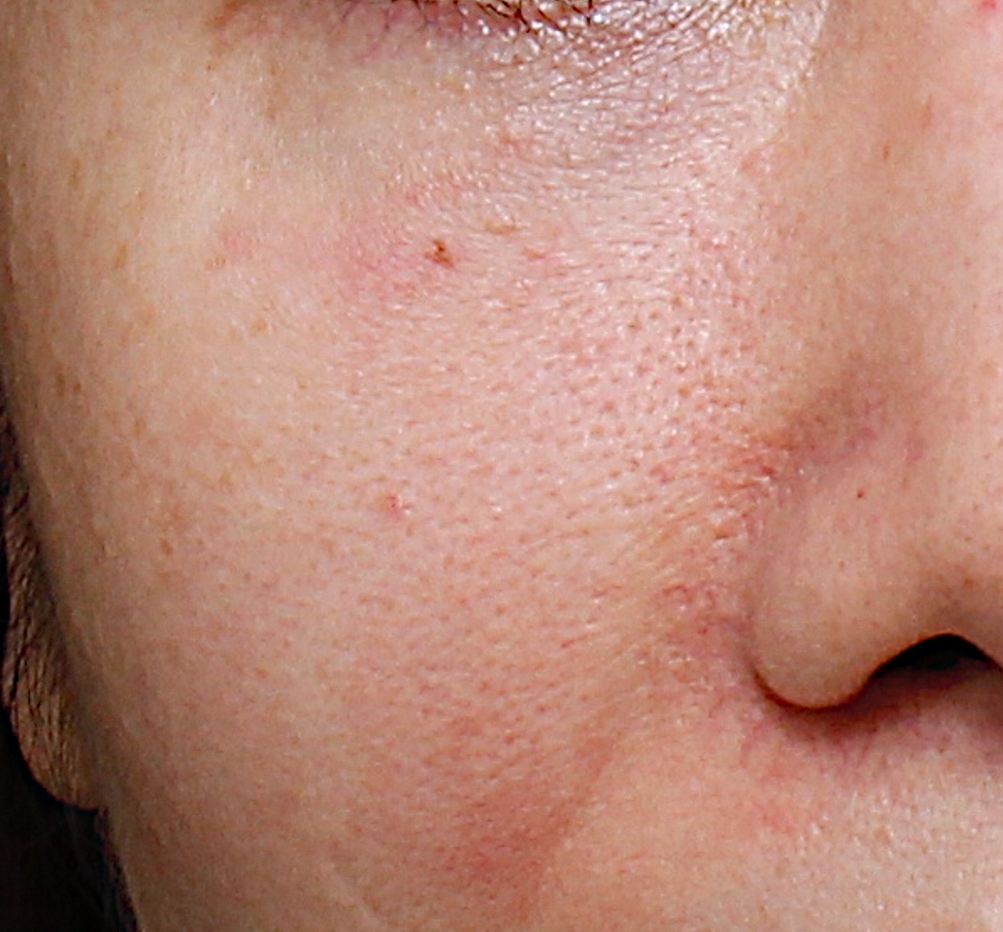 ultra_dr-may-lee_pore-size-and-dystonia_ba_before