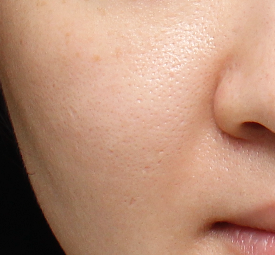 ultra_dr-may-lee_pore-size-and-erythema_ba_after-3-sessions
