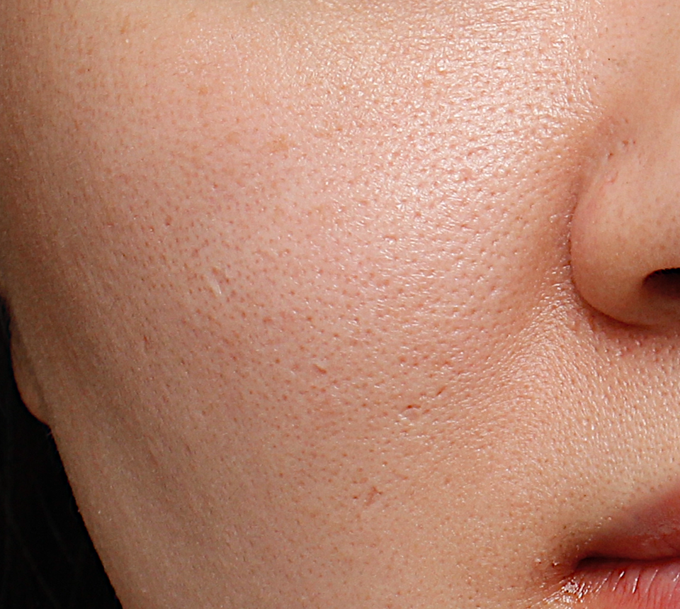 ultra_dr-may-lee_pore-size-and-erythema_ba_before