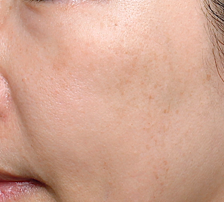 ultra_dr-may-lee_skin-rejuvenation-and-pigmentation_ba_2_after-1-session