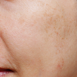 ultra_dr-may-lee_skin-rejuvenation-and-pigmentation_ba_2_before