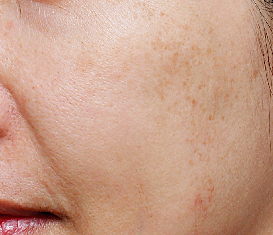 ultra_dr-may-lee_skin-rejuvenation-and-pigmentation_ba_2_before