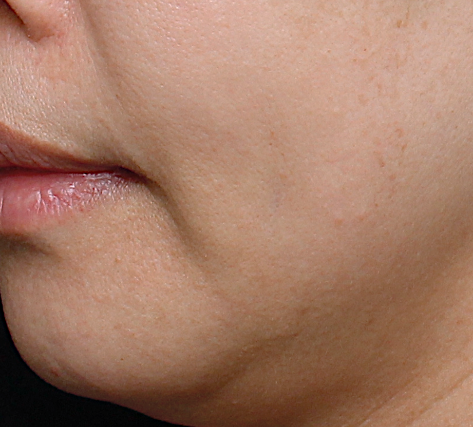 ultra_dr-may-lee_skin-rejuvenation-and-pigmentation_ba_3_after-1-session