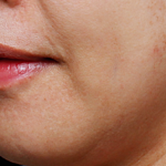 ultra_dr-may-lee_skin-rejuvenation-and-pigmentation_ba_3_before