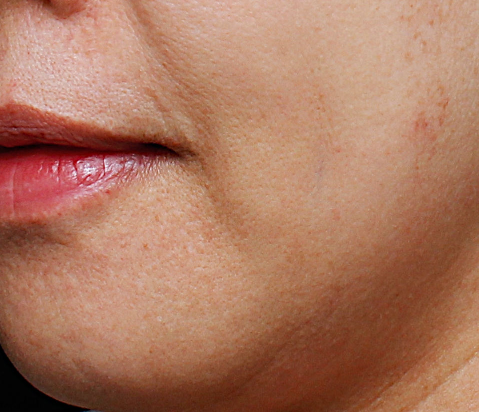 ultra_dr-may-lee_skin-rejuvenation-and-pigmentation_ba_3_before