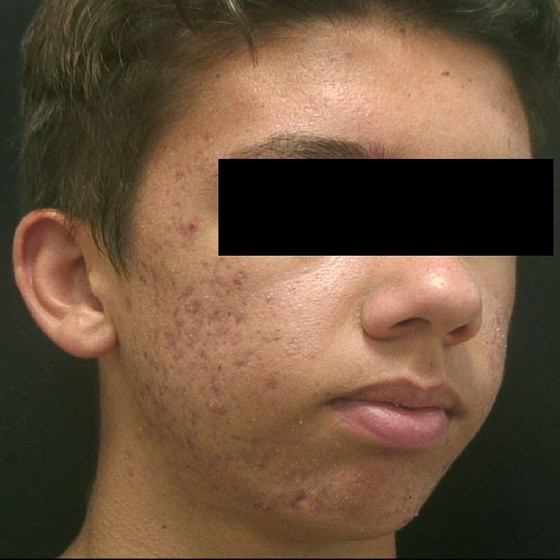 Vivace™ RF Microneedling device - before and after image - before - Aiden