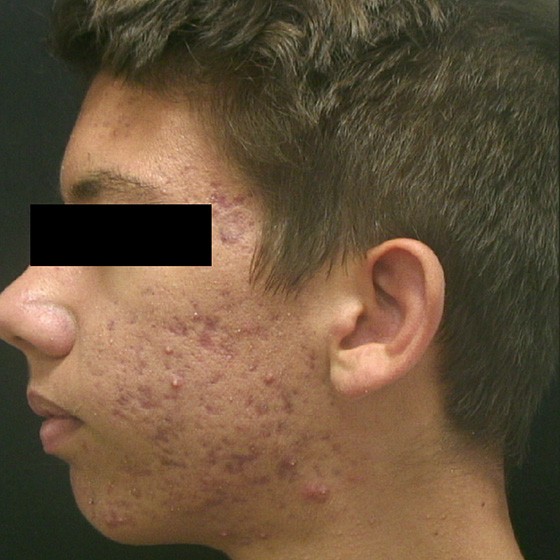 Vivace™ RF Microneedling device - before and after - Aiden 002