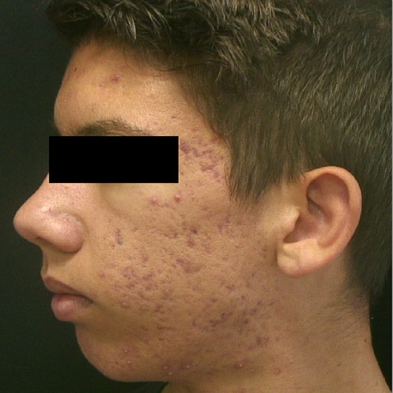 Vivace™ RF Microneedling device - before and after - after - Aiden