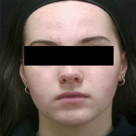 Vivace™ RF Microneedling device - before and after - after image 001 - Isabelle