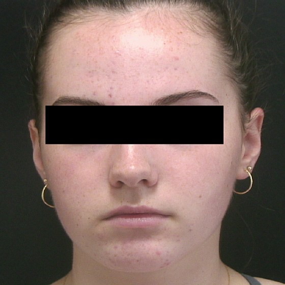 Vivace™ RF Microneedling device - before and after - before 001 - Isabelle