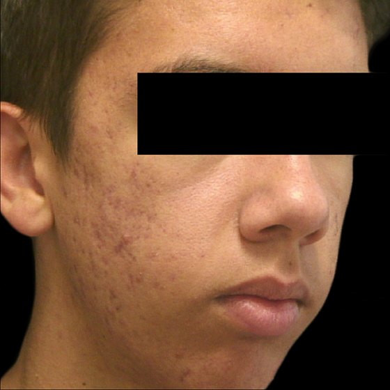 Vivace™ RF Microneedling - before and after 001 - after 18 days - right