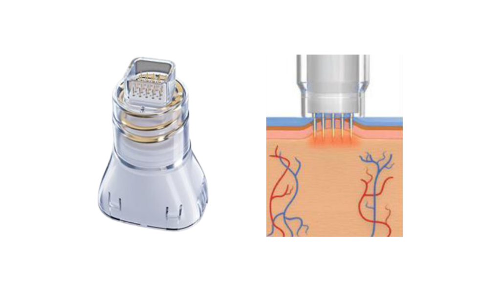 new-fusion-tip-image